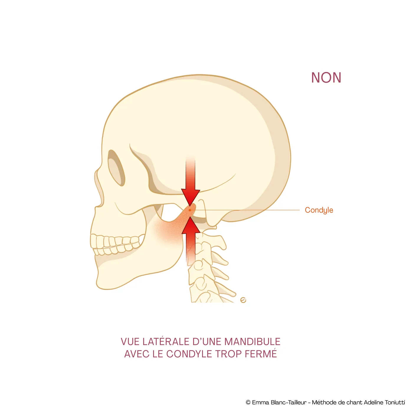 Vue latérale d’une mandibule avec le condyle trop fermé, crâne de profil