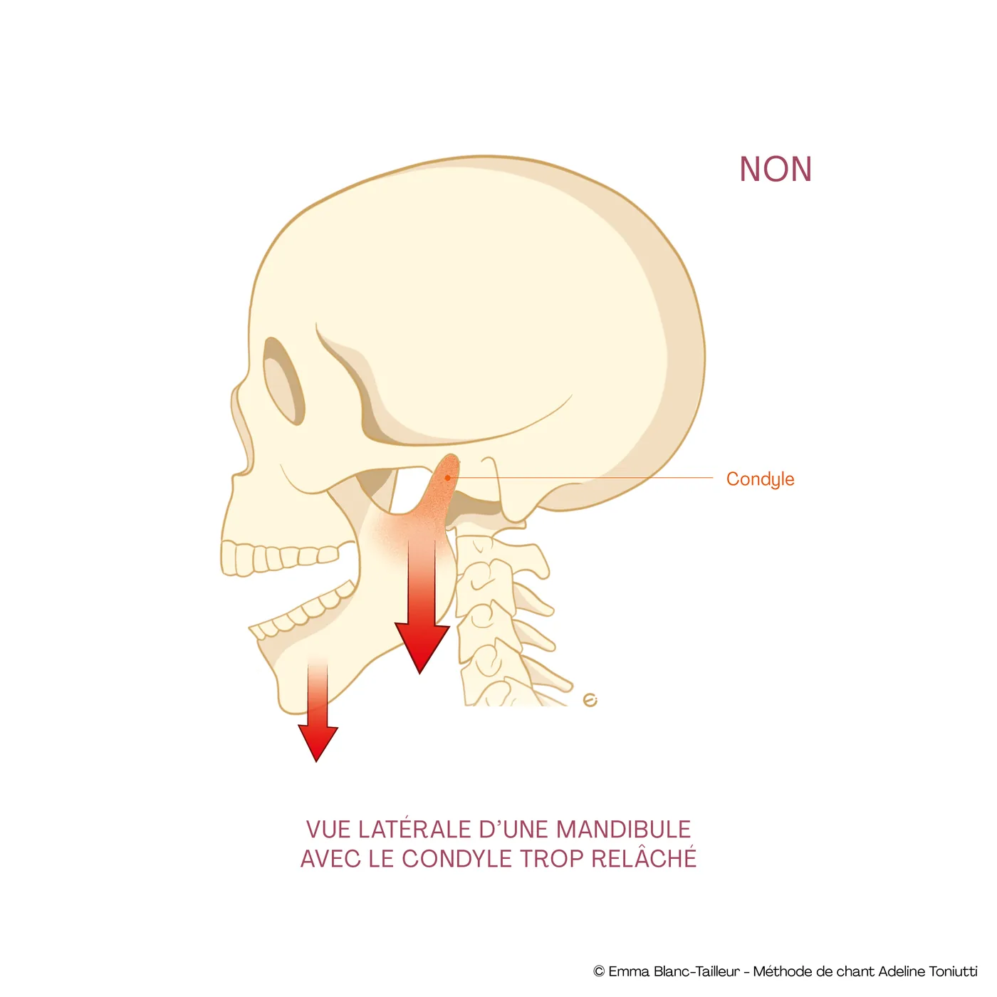 Vue latérale d’une mandibule avec le condyle trop relâché, crâne de profil