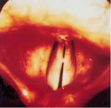 Laryngitis of the vocal cords