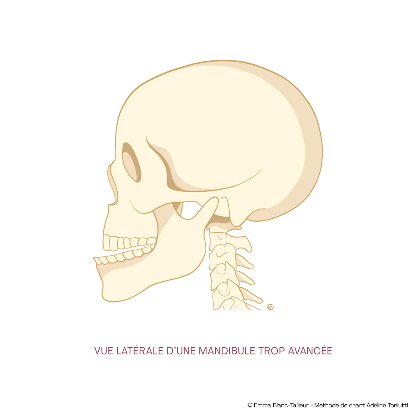 Vue latérale d’une mandibule trop avancée, crâne de profil
