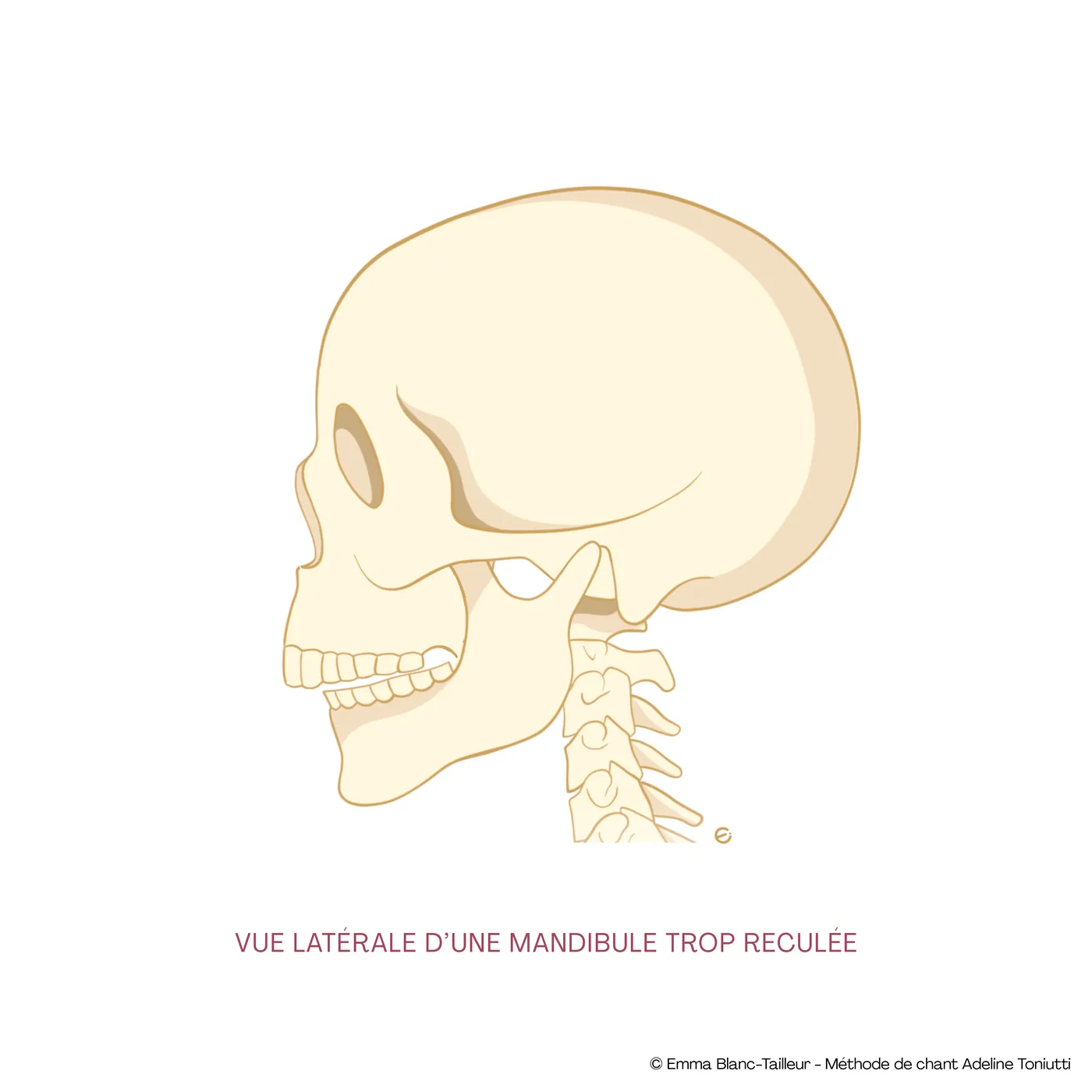 Vue latérale d’une mandibule trop reculée, crâne de profil