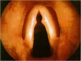 Узелки голосовых связок — ларингоскопический вид