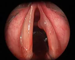 Vocal cord polyp
